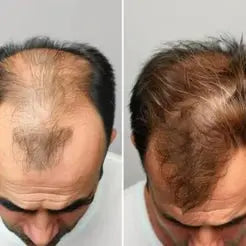 Proskire Hair Growth Serum – Reduces Hair Fall, Boosts Hair Density, Activates Follicles – For Bald Patches, Receding Hairline & Thinning Hair | BUY 1 GET 1 FREE