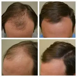 Proskire Hair Growth Serum – Reduces Hair Fall, Boosts Hair Density, Activates Follicles – For Bald Patches, Receding Hairline & Thinning Hair | BUY 1 GET 1 FREE